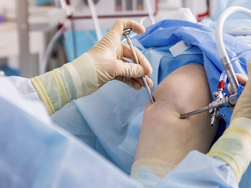 Arthroscopy